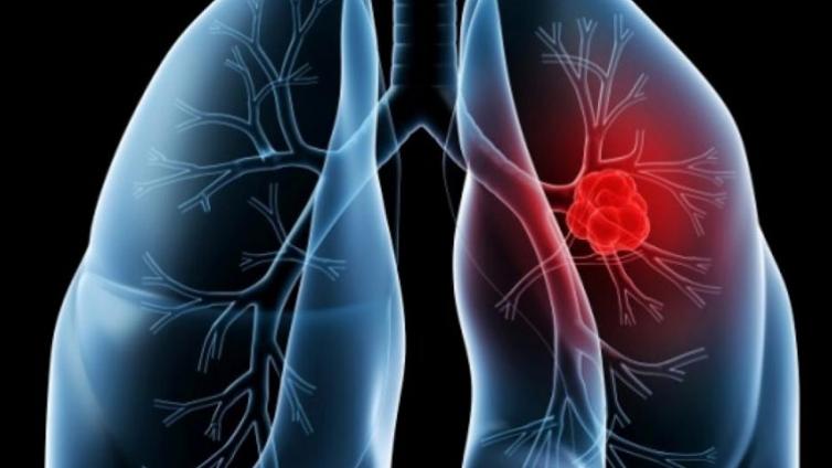 早期微小肺癌的影像学诊断——小肺癌预后