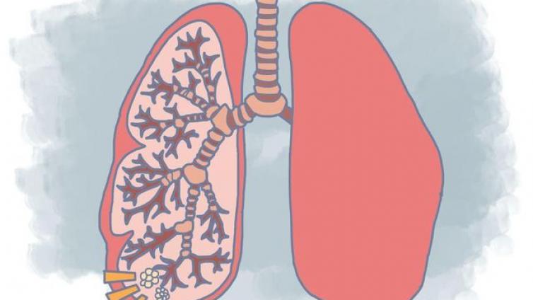 微小肺癌CT形态演变转化规律