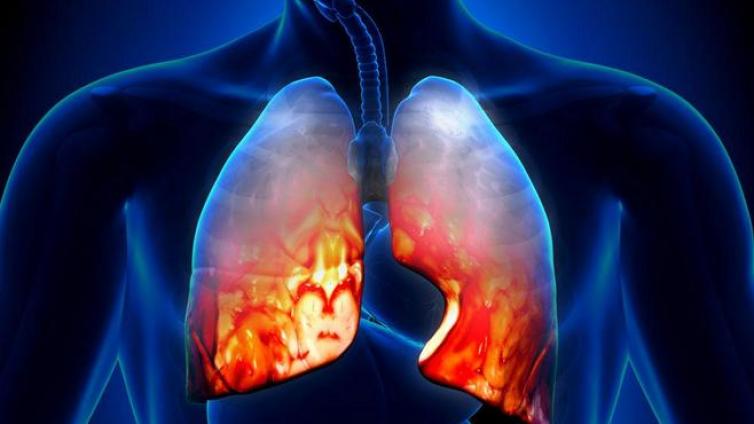 肺癌影像学筛查进展——结节的处理