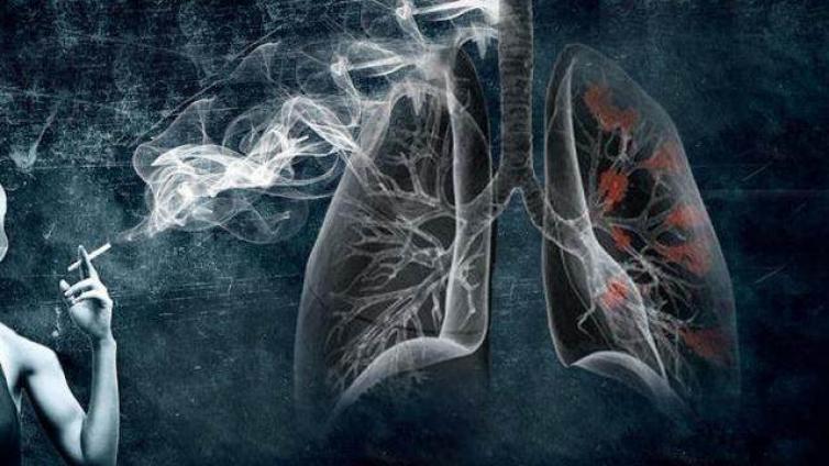 肺癌影像学筛查进展——概述