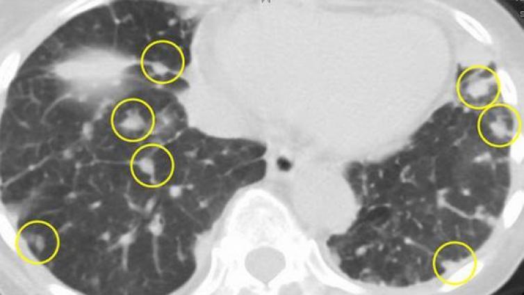 肺结节的CT观察方法——肺结节的分类