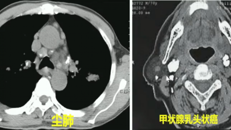 头颈部淋巴结解剖与疾病——小结