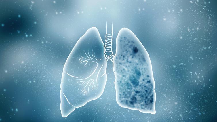 肺结节影像分级与评估系统——PNI-GADS分级评估系统的临床运用（中）