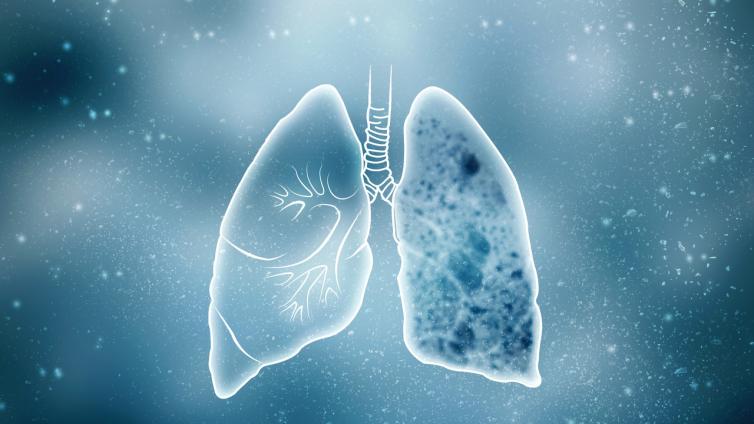 肺结节影像分级与评估系统——PNI-GADS系统的重要指标（2）