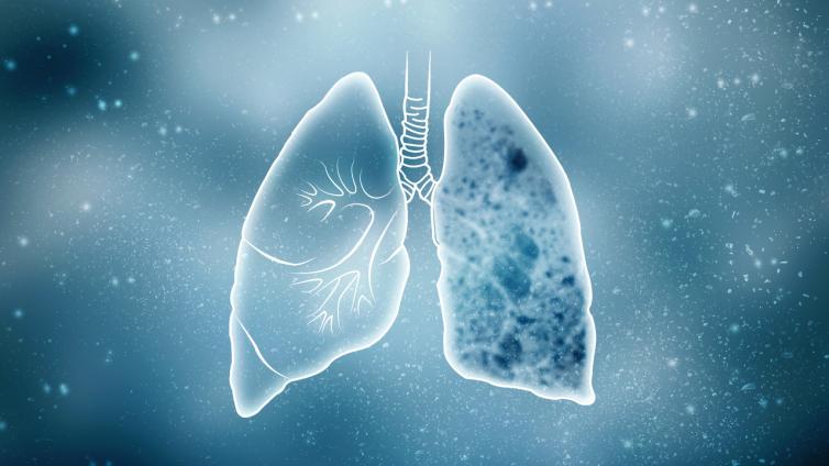 肺结节影像分级与评估系统——概述
