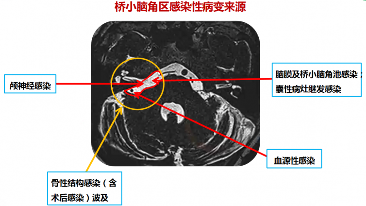 桥小脑角区感染性病变来源及其解剖基础