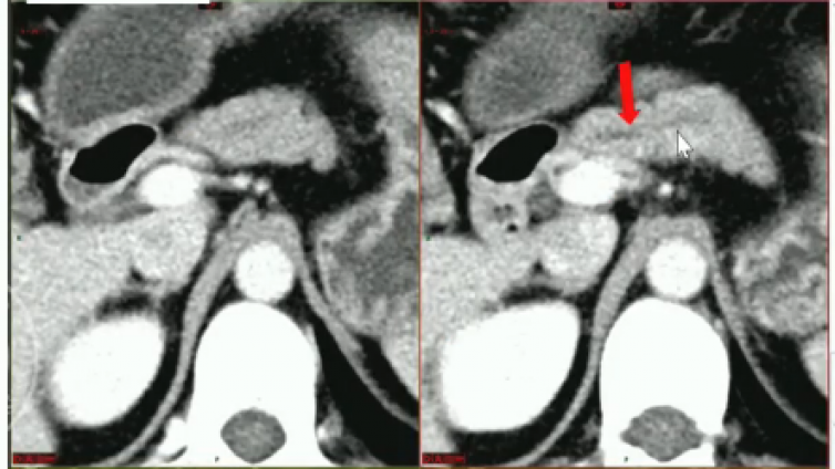 不典型胰腺导管腺癌影像特征