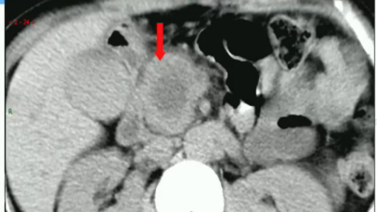 胰腺导管腺癌典型和不典型的影像征象（小结1）