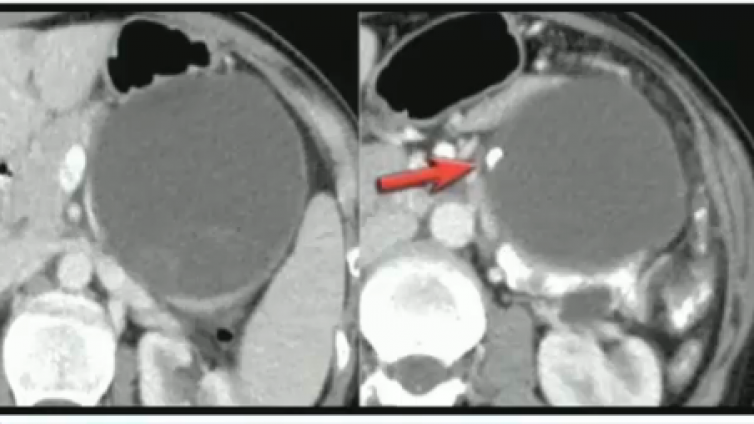 胰腺导管腺癌典型和不典型的影像征象（小结2）