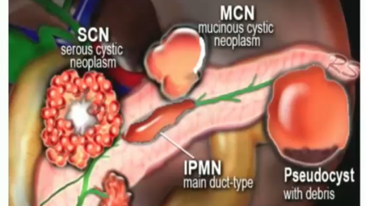 胰腺囊性病变的分类