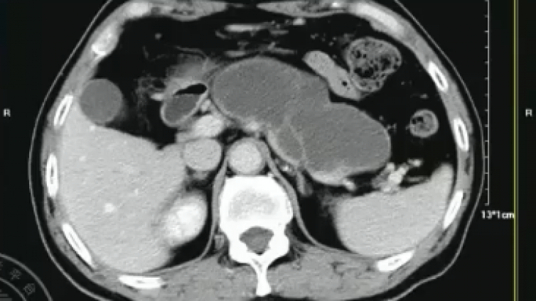 胰腺导管腺癌典型和不典型的影像征象（小结3）