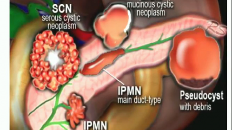 胰腺囊性病变的诊断与鉴别——概述