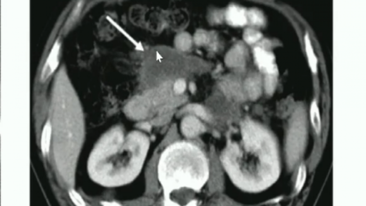 胰腺炎相关的囊性病变——胰腺的包裹性坏死(walled-offnecroses，WONs)
