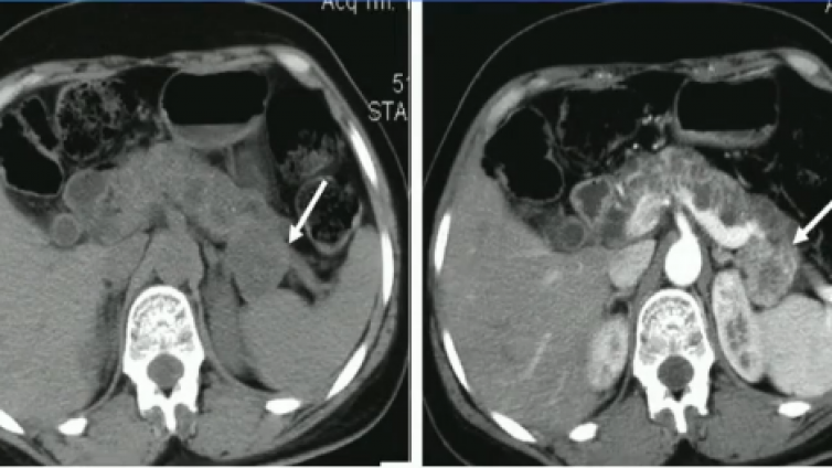 胰腺真性囊肿——von Hippel-Lindau (VHL)病 