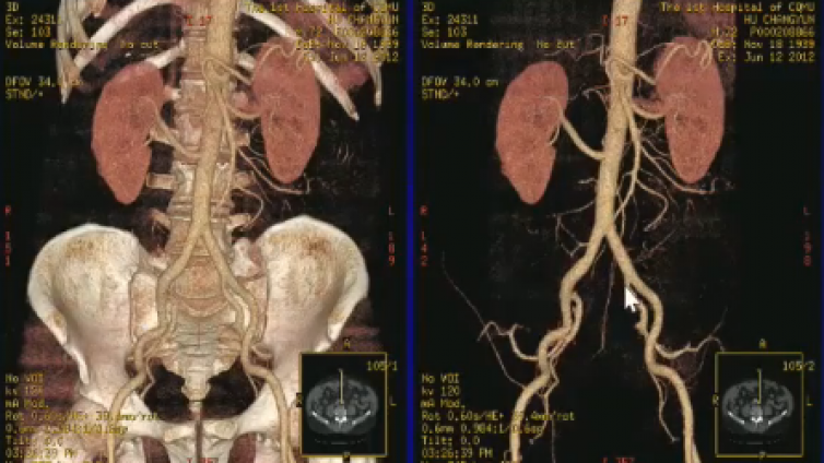 腹部CT图像后处理技术及步骤