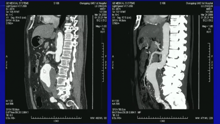 腹主动脉病变（上）