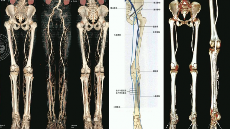 四肢CTA/CTV——血管解剖、后处理规范