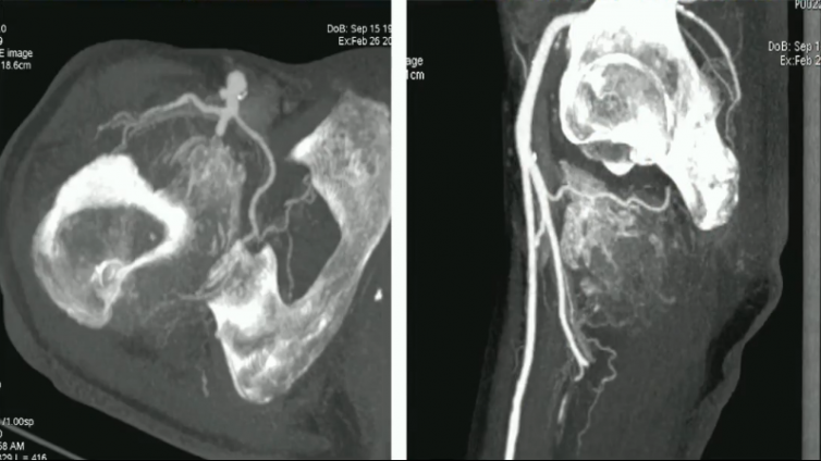 四肢CTA—动脉瘤、海绵状血管瘤