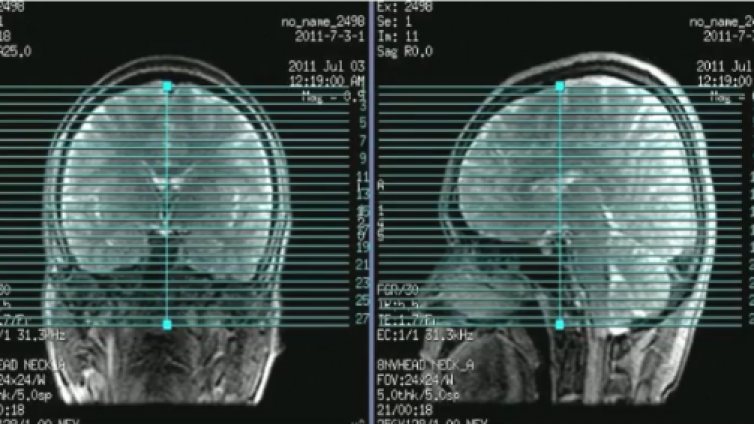 fMRI横断面BOLD定位像、成像序列及参数