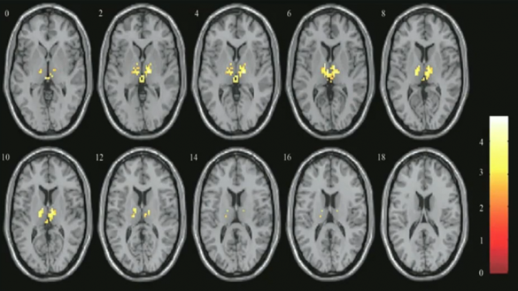 fMRI扫描的质量控制、扫描技术