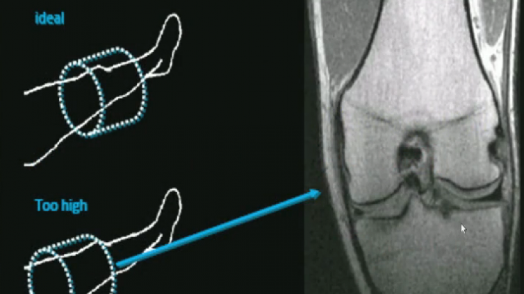 膝关节损伤MRI诊断——半月板MRI
