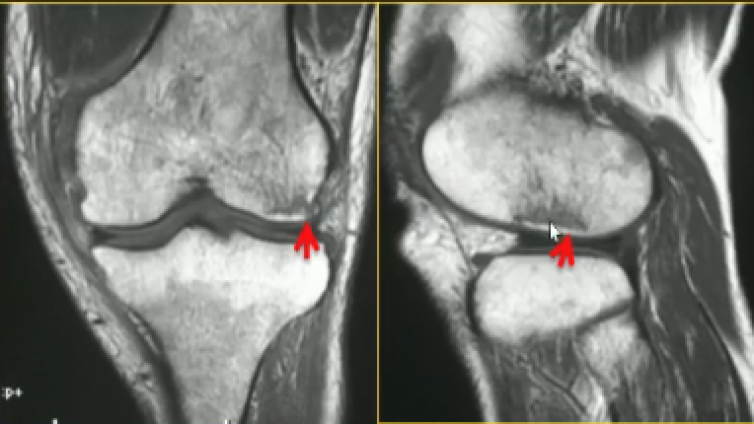 膝关节损伤MRI诊断小结