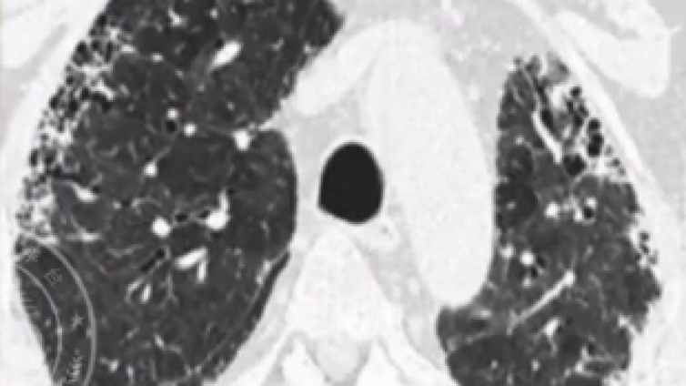 间质性肺疾病概述及病理影像