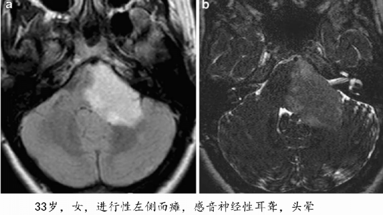 桥小脑角区病变——典型肿瘤（1）