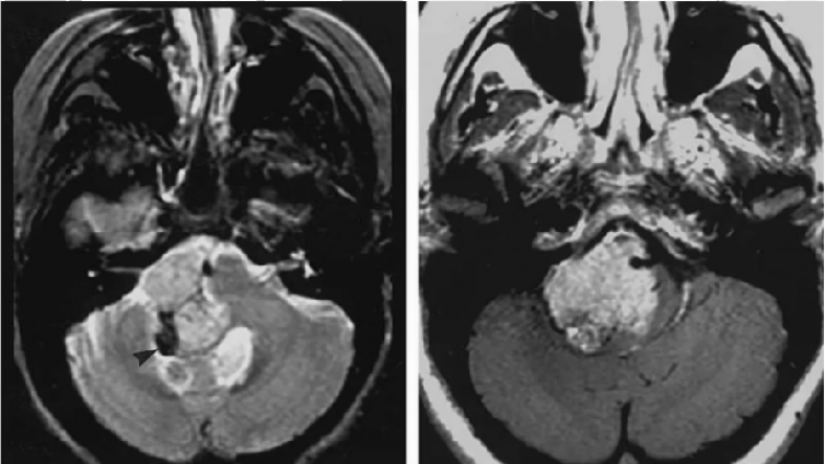 桥小脑角区病变——典型肿瘤（2）