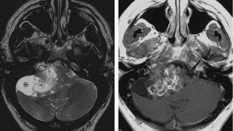 桥小脑角区病变——典型肿瘤（3）