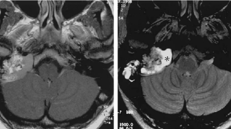 桥小脑角区病变——典型肿瘤（4）