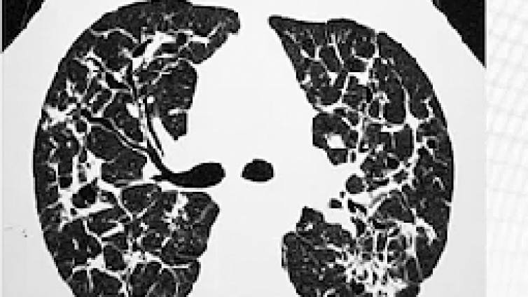 肺内多发小结节的解剖分布类型：依据解剖分布（上）
