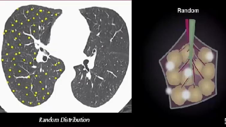 肺内多发小结节的解剖分布类型：依据解剖分布（下）