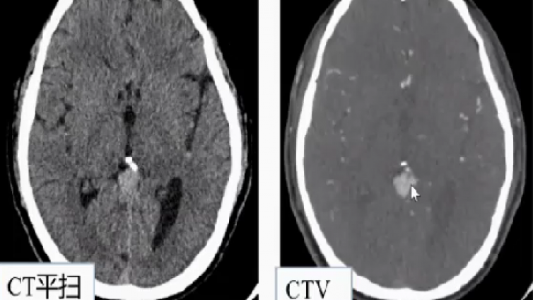 中枢神经系统血管畸形的临床表现——VGM、VBD
