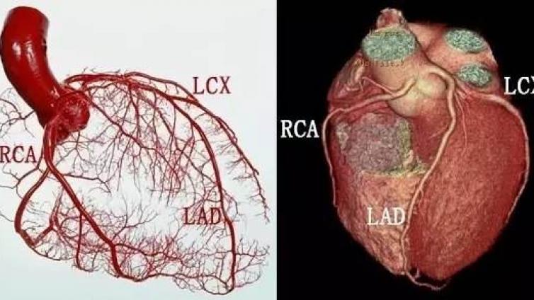 冠脉CTA扫描技术——适应症、禁忌症