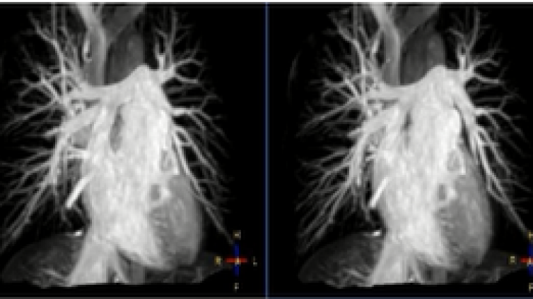 磁共振腹部选择性血管成像技术：下腔静脉、心血管