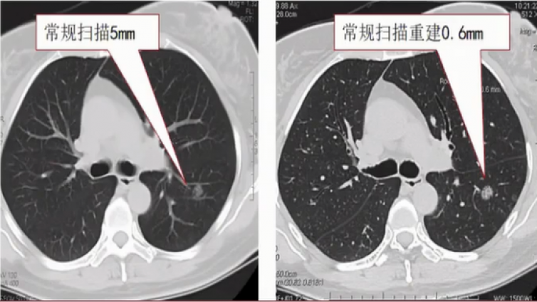 CT扫描中对诊断质量的影响因素（5）