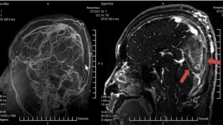 急性静脉性脑血管病影像指导规范（MR检查模式）