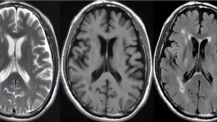 脑血管病磁共振检查成像技术规范  （一）MR检查前准备统一说明