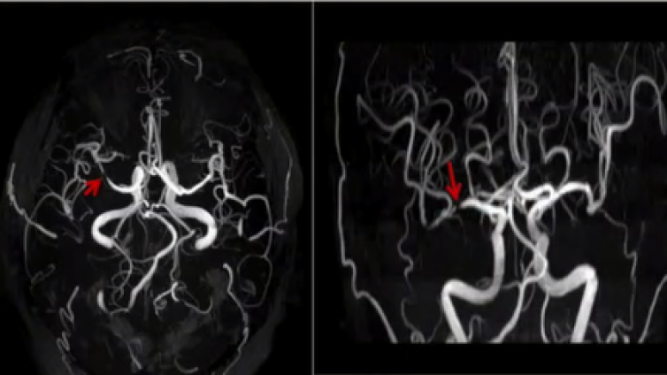 脑血管病磁共振检查成像技术规范（四） MRA——上