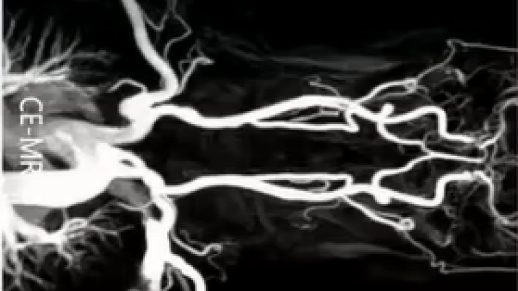 脑血管病磁共振检查成像技术规范（四） MRA——中