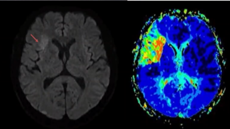 脑血管病磁共振检查成像技术规范（五）MRP——上