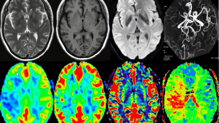 脑血管病磁共振检查成像技术规范（五）MRP——下