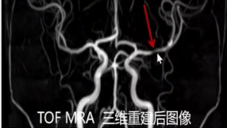 脑血管病磁共振检查成像技术规范（六）MRWI——下
