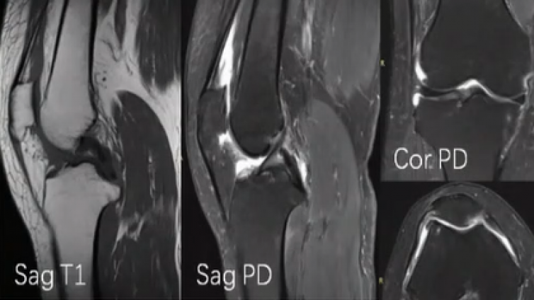 膝关节MRI检查优势及局限