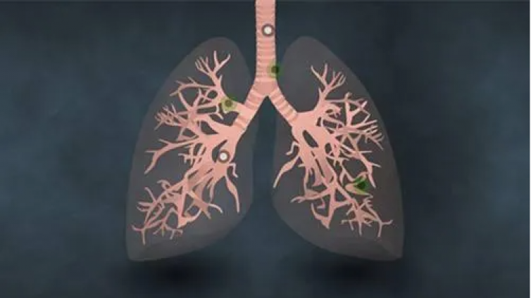 空气污染引发肺癌机制确定