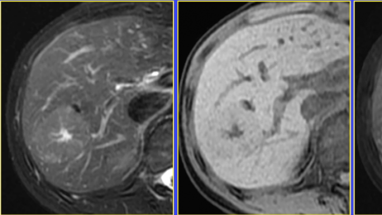 肝脏MR图像判读常见误区/陷阱与对策——瘢痕的判读