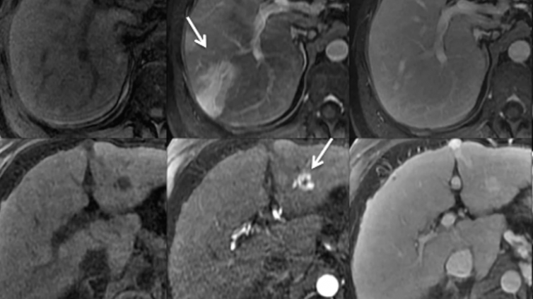 肝脏MR图像判读常见误区/陷阱与对策——肝胆期等高强化还是低强化的判读