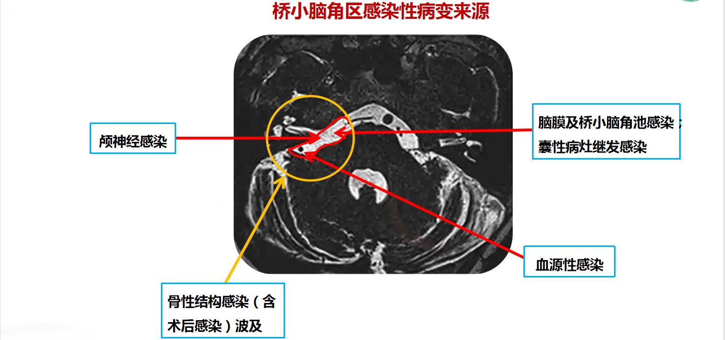 桥小脑角区感染性病变来源